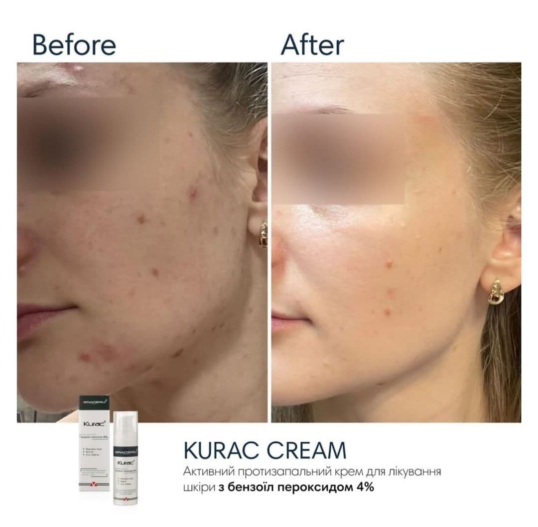Активний протизапальний крем з бензоїл пероксидом 4% Braderm Kurac Cream 2