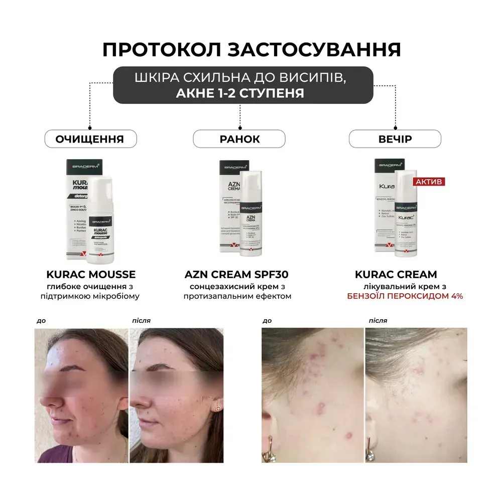 Активний протизапальний крем з бензоїл пероксидом 4% Braderm Kurac Cream 2