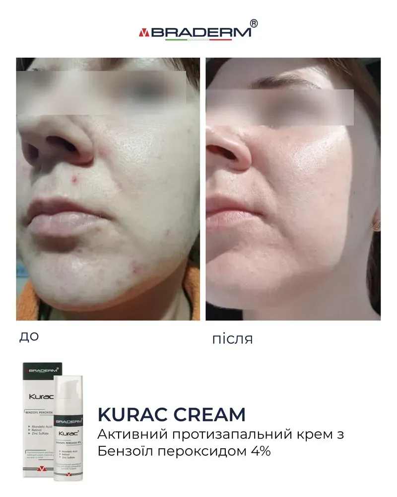 Активний протизапальний крем з бензоїл пероксидом 4% Braderm Kurac Cream 5