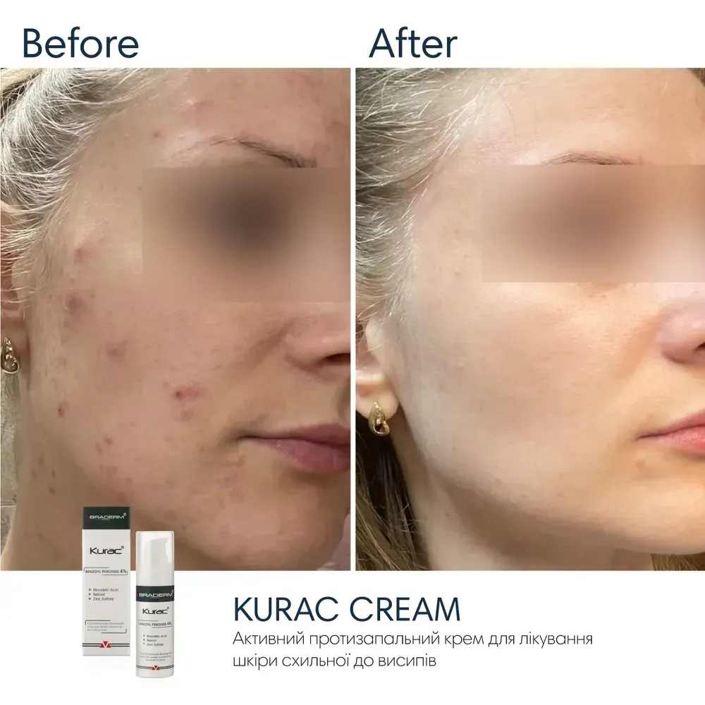 Активний протизапальний крем з бензоїл пероксидом 4% Braderm Kurac Cream 6