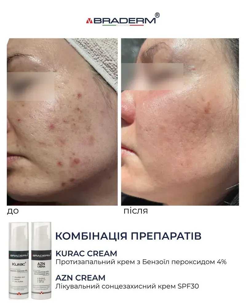 Активний протизапальний крем з бензоїл пероксидом 4% Braderm Kurac Cream 7