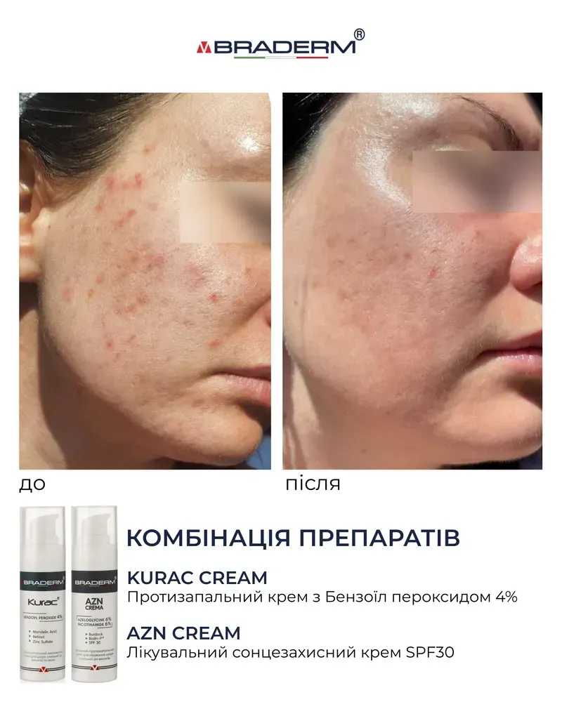 Активний протизапальний крем з бензоїл пероксидом 4% Braderm Kurac Cream 8