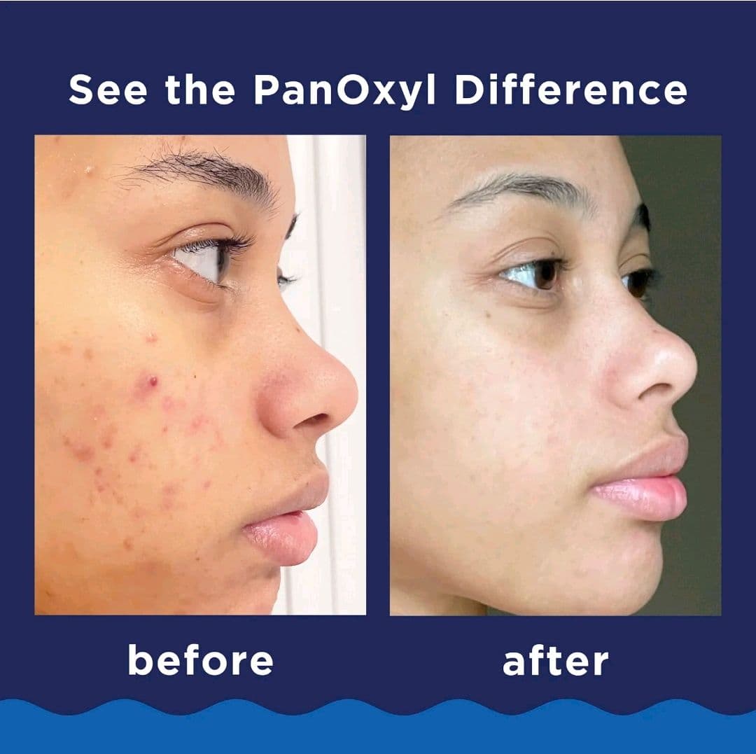 Гель для вмивання з бензоїл пероксидом 10% проти АКНЕ PanOxyl Acne Foaming Wash Benzoyl Peroxide 10% Maximum Strength Antimicrobial 2