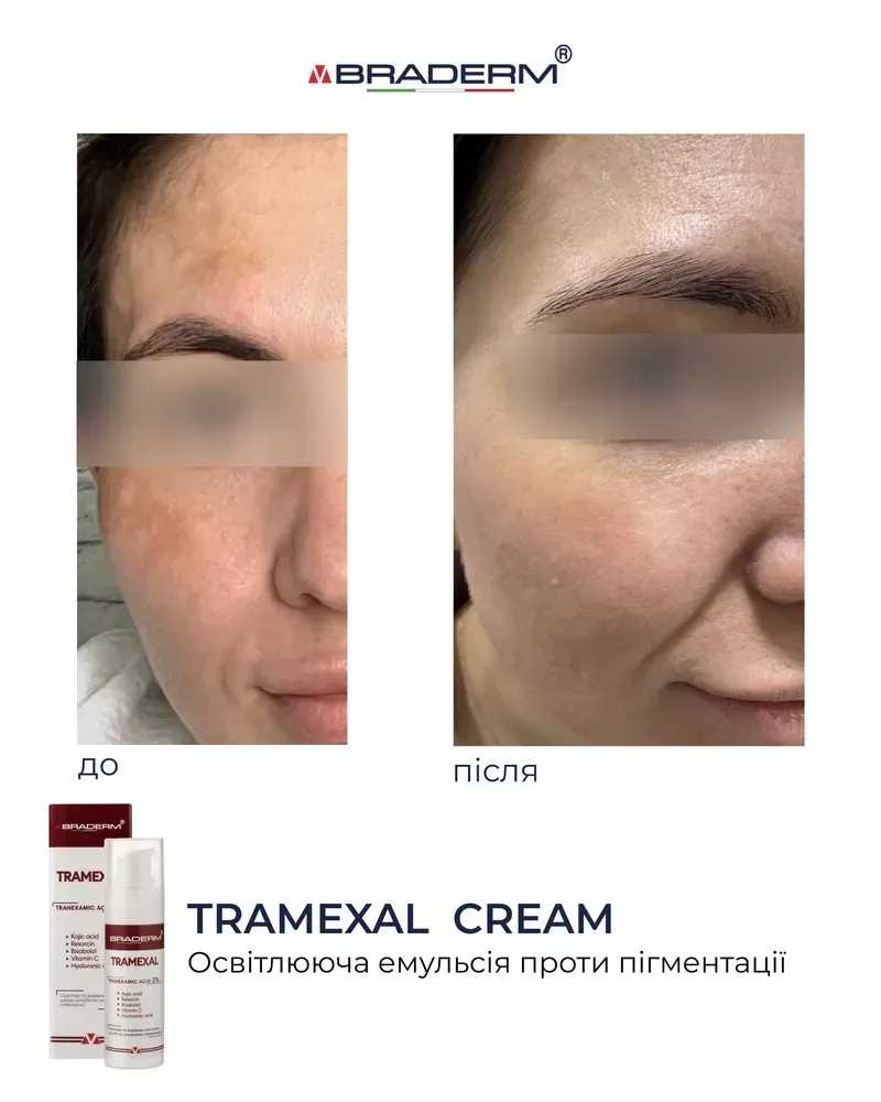 Освітлююча емульсія проти пігментації Braderm Tramexal Cream 2