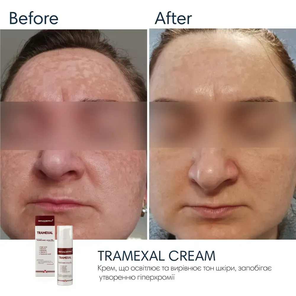Освітлююча емульсія проти пігментації Braderm Tramexal Cream 3