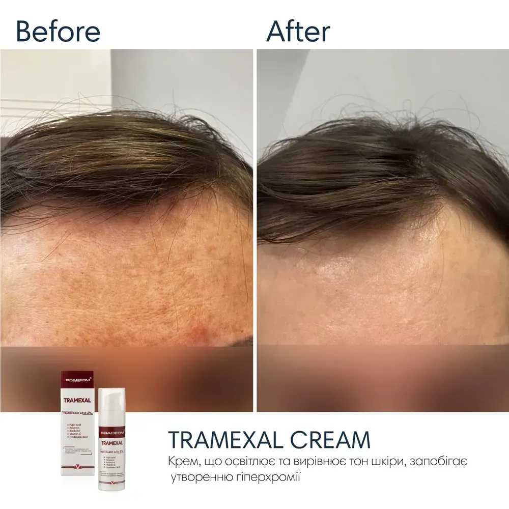 Освітлююча емульсія проти пігментації Braderm Tramexal Cream 4