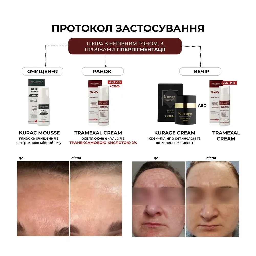 Освітлююча емульсія проти пігментації Braderm Tramexal Cream 5