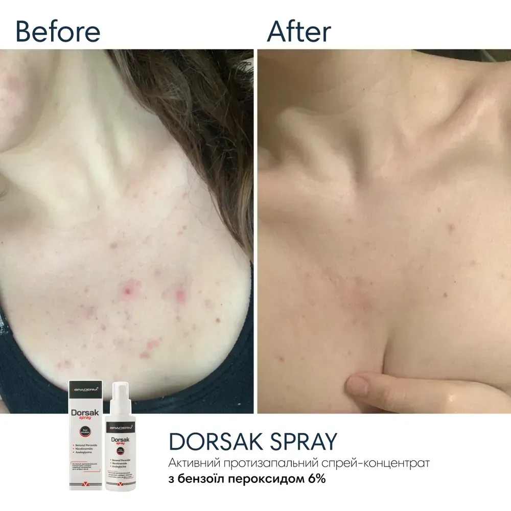 Активний протизапальний спрей з Бензоїл пероксидом 6% проти акне на тілі Braderm Dorsak Spray 3