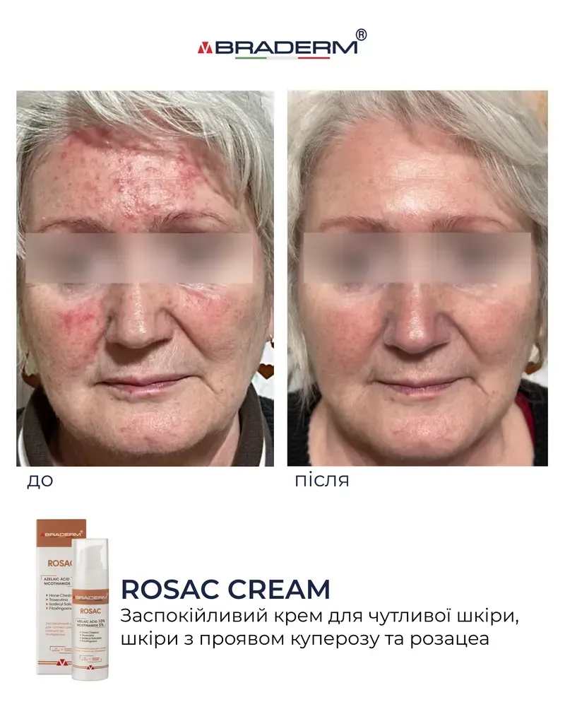 Заспокійливий крем для чутливої шкіри Braderm - Rosac Cream 2