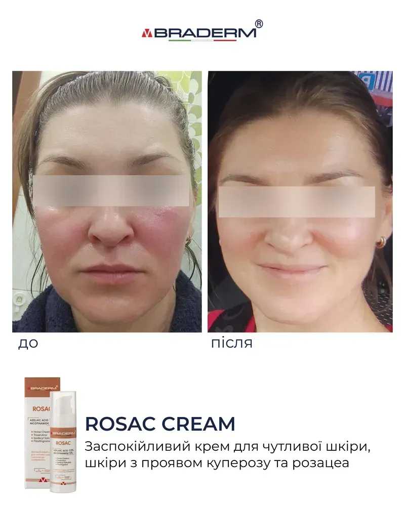 Заспокійливий крем для чутливої шкіри Braderm - Rosac Cream 3