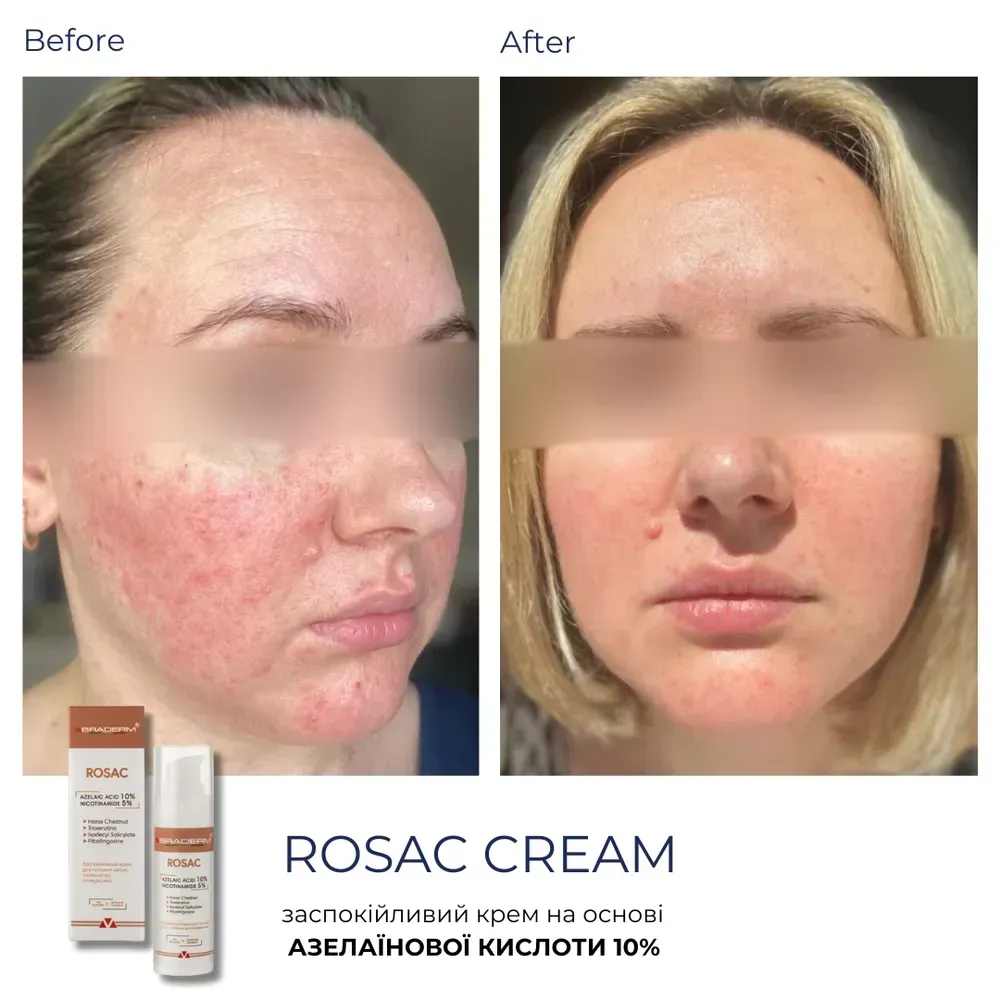 Заспокійливий крем для чутливої шкіри Braderm - Rosac Cream 4